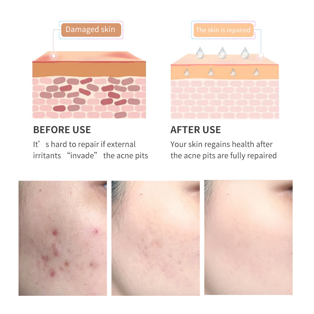Breylee Acne Scar Removal Gel Comparison